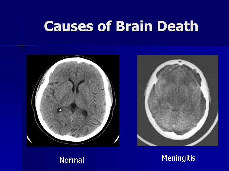 Causes of Brain Death Normal Meningitis